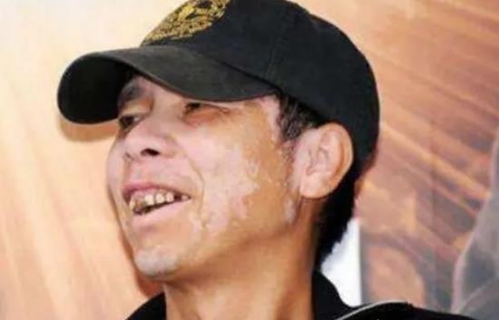 馮小剛得白癜風的原因，一般活多久？