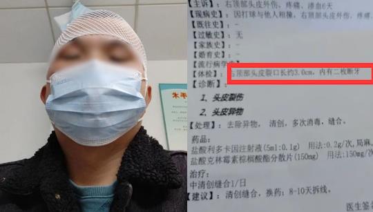 男子打球6天后頭皮里發(fā)現(xiàn)2顆牙,網(wǎng)友神評(píng)論
