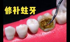 “10歲娃用牙洞修復(fù)牙膏后損失6顆牙”火的原因醫(yī)生說出了真相