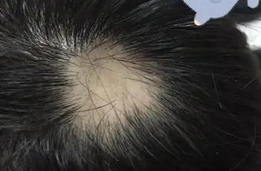 頭發(fā)禿了一塊是什么原因造成的