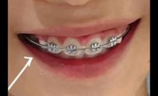 矯正牙齒可以報(bào)銷醫(yī)保嗎兒童(矯正牙齒可以報(bào)銷醫(yī)保嗎)