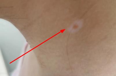 白痣是怎么回事 白痣是什么原因引起的