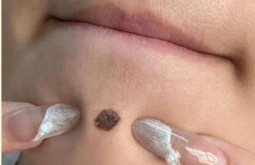 正規(guī)醫(yī)院取一顆痣多少錢 醫(yī)院祛痣一般多少錢一顆