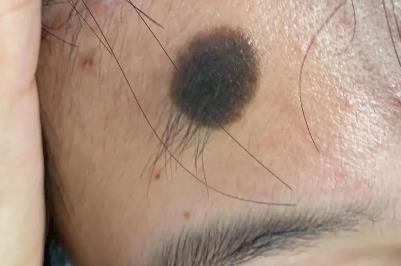 娘胎里帶來的黑色素胎記會惡變嗎 娘胎里的痣會掉嗎