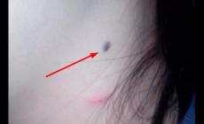 醫(yī)院祛痣掛什么科室 醫(yī)院祛痣掛什么科室的號