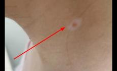 白痣是怎么回事 白痣是什么原因引起的