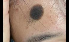 娘胎里帶來的黑色素胎記會惡變嗎 娘胎里的痣會掉嗎